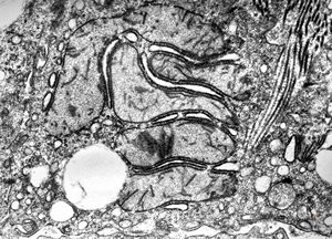 F,1y. | mitochondrial changes - Reye hepatocerebral syndrome F,1y. | mitochondrial changes - Reye hepatocerebral syndrome